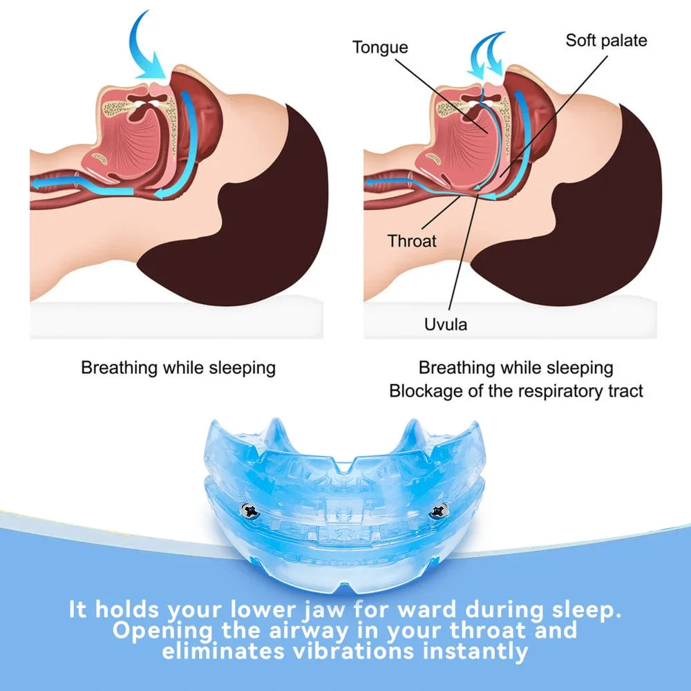 Anti Snoring Mouth Guard